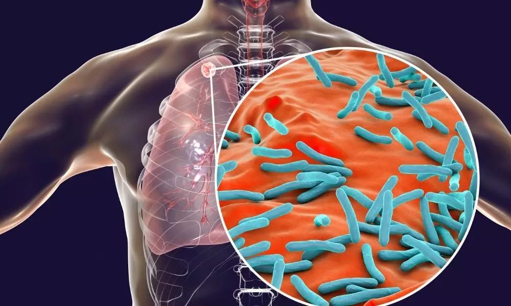 Malaysia Catat 503 Kes Baharu Batuk Tibi